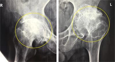 Case report: A 3-year follow-up study of simultaneous bilateral total hip arthroplasty for Femoral head necrosis in a patient with Kashin-Beck Disease